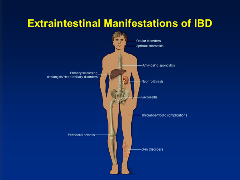PGP30PPTEIMSofIBD768.jpg